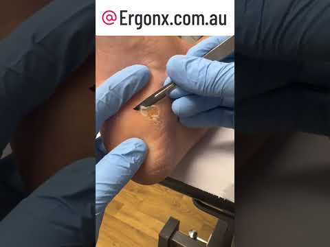 Ultimate Satisfying Heel Callus Removal Transformation #Podiatrist #FootCare