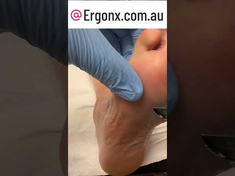 Satisfying Callus Removal: Watch a Podiatrist in Action! #Satisfying #CallusRemoval