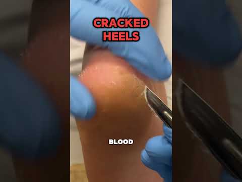 🦶 Thick Tradie’s Heel 😬 Ever wondered why tradies get such thick, cracked heels? The answer is