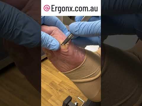 Amazing Foot Transformation Deep Callus Removal by Skilled Podiatrist #FootCare #Podiatry