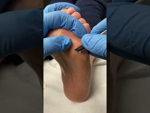 Say goodbye to those pesky corns! 👋✨ Witness the amazing transformation as we tackle stubborn foot