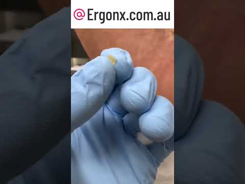 Satisfying Corn Removal Relief Painful Foot Transformation #FootCare #Podiatry