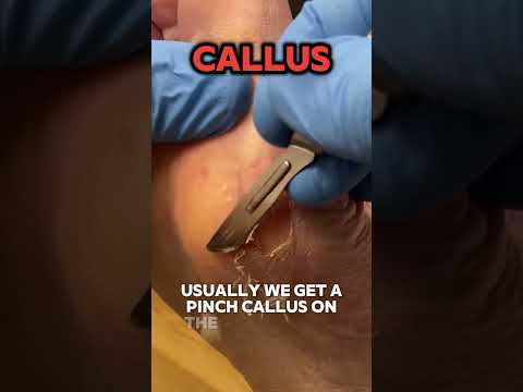 Understanding and Managing Pinch Calluses on Your Feet