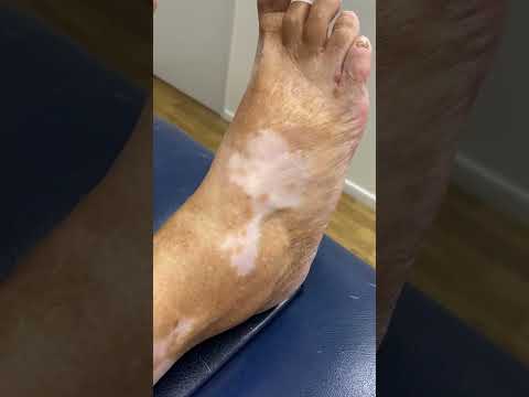 Discover the beauty of diversity with vitiligo ✨ Embrace the unique patterns and let your true