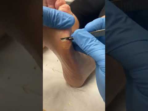Transform your feet with this ultimate hard skin removal! Watch as a skilled podiatrist works magic