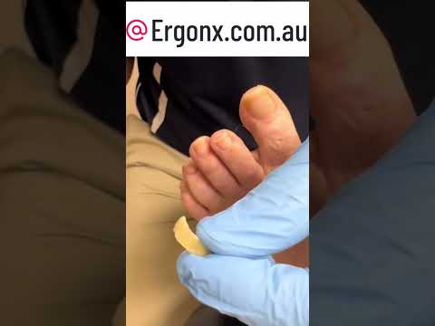 Satisfying Long Toenail Transformation Cutting Overdue Nails ASMR #ToenailCare #SatisfyingVideos