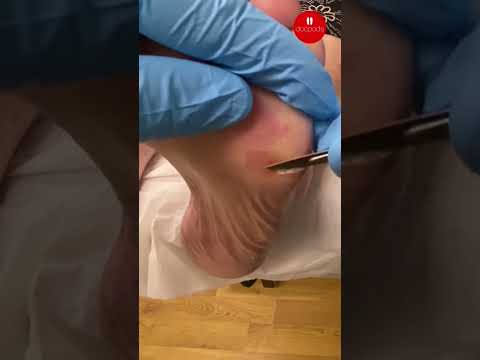Painful Foot Corns: Podiatry Treatment Explained