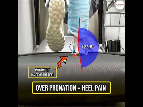 Overpronation and Heel Pain: The Connection