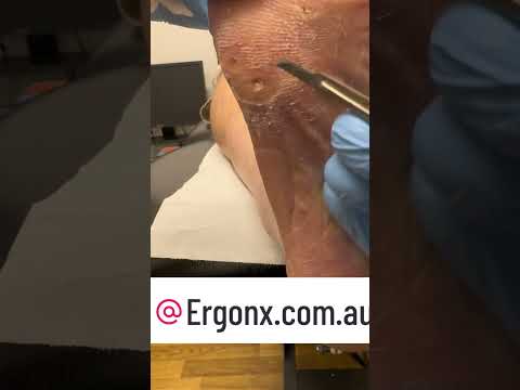 Podiatrist Removes Painful Corn - Foot Transformation #FootCare #Podiatrist