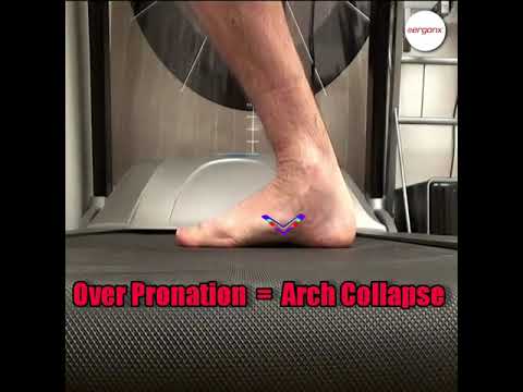 Discover how to tackle overpronation and conquer collapsed arches with ease! 👟💪 Transform your
