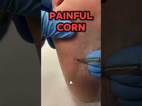 Painful Corn 😖🦶 Ever wondered why a corn can become so incredibly painful? In today’s video, I’m