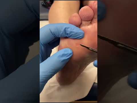 Watch as a skilled podiatrist tackles a painful corn removal! Say goodbye to discomfort and hello to