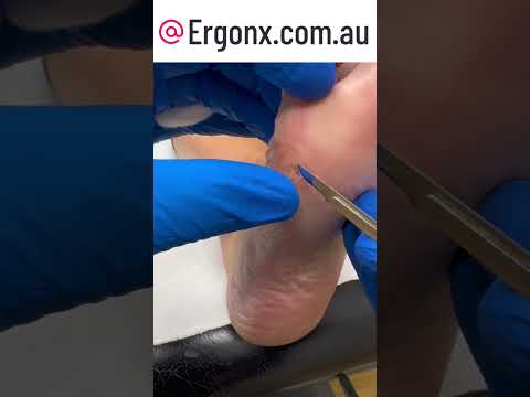 Ultimate Corn Removal: Watch Pain Disappear at This Podiatry Clinic! #FootCare #Podiatry