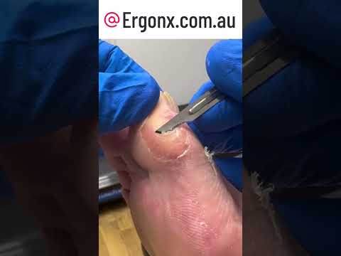 Podiatry Clinic: Watch a Big Toe Callus Cut with a Scalpel for Amazing Results #FootCare #Podiatry