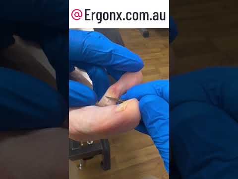 Say Goodbye to Toe Pain: Watch a Podiatrist Remove a Corn Between Toes #FootCare #Podiatry