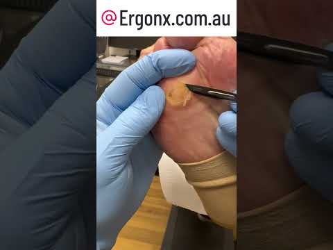 Podiatrist's Painful Corn & Callus Removal - Watch the Transformation #Podiatry #FootCare