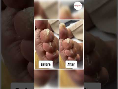 How to Deal with a Corn on the Tip of Your Toe