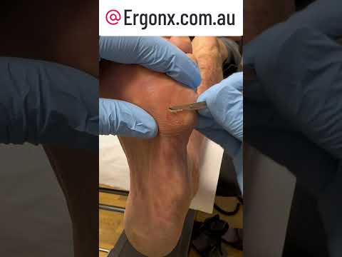 Oddly Satisfying Hard Corn Removal with Scalpel by Podiatrist #Podiatry #SatisfyingRoutine