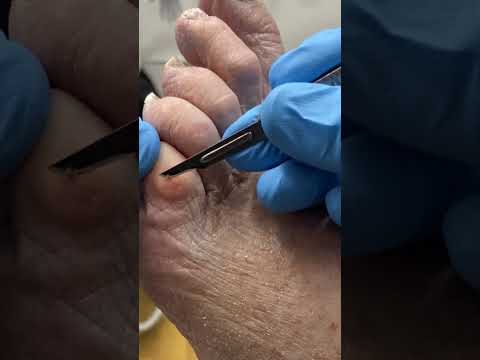 Struggling with a painful corn on your little toe? 😣 Discover easy remedies to say goodbye to that