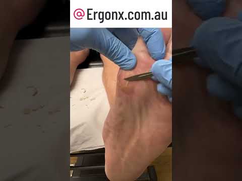 Satisfying Callus Removal by Top Australian Podiatrist #FootCare #CallusRemoval