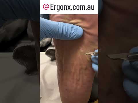 Satisfying Corn Removal by Podiatrist Watch the Transformation #FootCare #CornRemoval