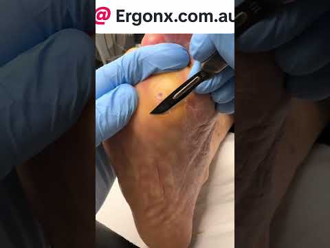 Forefoot Callus Removal: What to Know About Podiatry Care