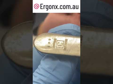 Podiatrist Corn Removal: Say Goodbye to Painful Corns on Your Feet #FootCare #Podiatry
