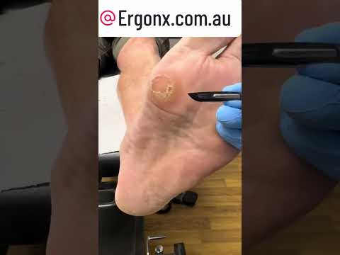 Satisfying Forefoot Callus Removal on Builder's Foot ASMR #FootCare #CallusRemoval