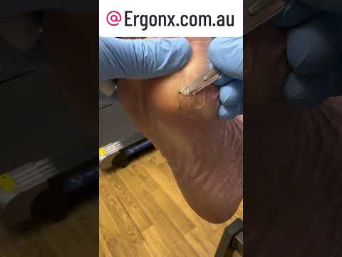 Ultimate Callus Removal Satisfaction Watch This Scalpel Skill in Action #Podiatry #Satisfying