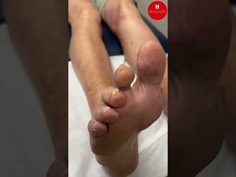 Check out this intense corn removal from the second toe! 🌟 Say goodbye to discomfort and hello to