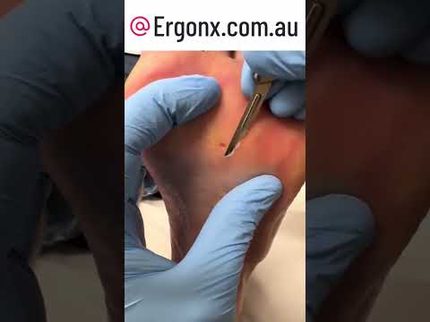 Satisfying Corn Removal from Foot Amazing Transformation #Podiatry #FootCare