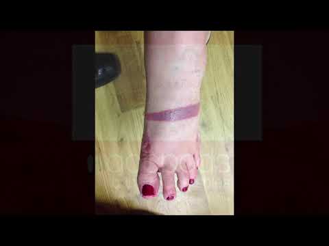 Discover the surprising signs of strapping tape & zinc oxide allergies 😲 Watch till the end to see