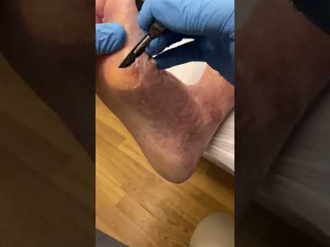 Watch as a pro podiatrist works magic on a thick bunion callus! 👣✨ Witness the satisfying