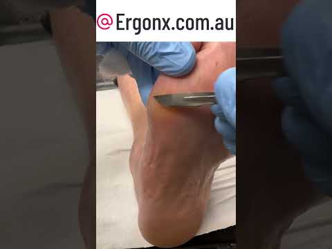 Amazing Foot Transformation at Podiatry Clinic Callus Cutting Procedure #Podiatry #FootCare
