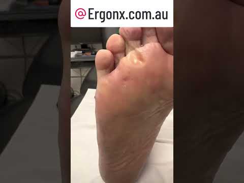 Podiatrist Removes Hard Forefoot Corn Live #FootCare #Podiatry