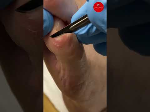 Painful Little Toe Corns: Causes and Treatment: Video Guide