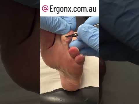 Podiatry Clinic: Watch Expert Callus Removal with Scalpel | #FootCare #Podiatry