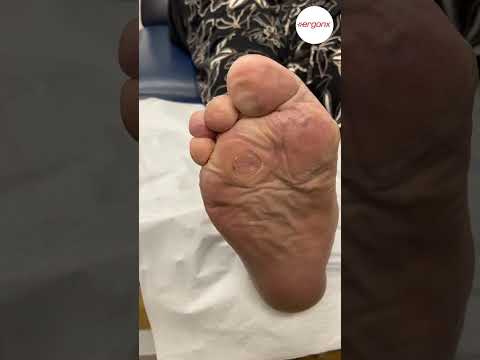Painful Foot Corns: Scalpel Removal Explained