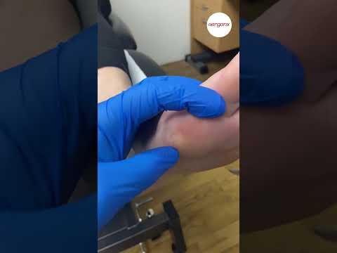 Bunion Callus Removal: What to Expect | ErgonX