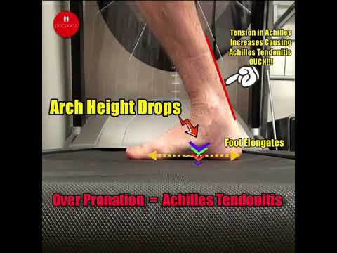 How Overpronation May Affect the Achilles Tendon