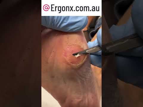 Satisfying Callus Removal in Slow Motion Foot Care Therapy ASMR #Satisfying #FootCare