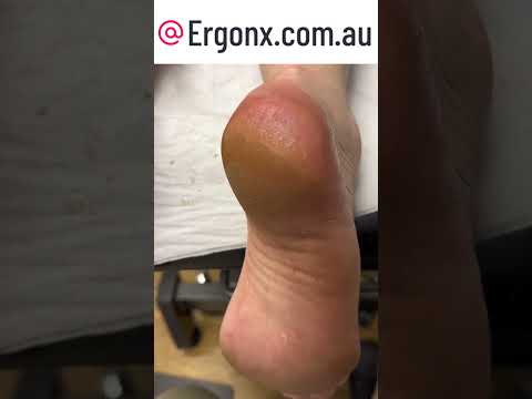 Satisfying Slow-Mo: Heel Callus Removal at Podiatry Clinic #Satisfying #Podiatry
