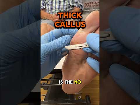 Painful Callus Under the Big Toe Joint (1st MTP Joint) In this video our podiatrist is removing a