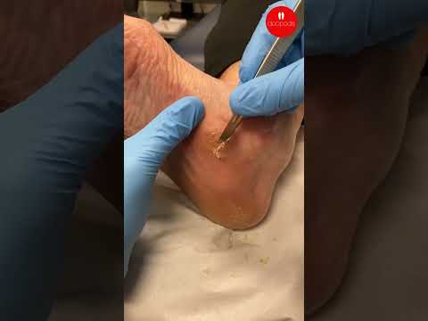 Midfoot Callus Removal and Arch Pressure Causes