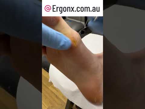 Satisfying Foot Callus Removal by Podiatrist in Australia #ASMR #FootCare