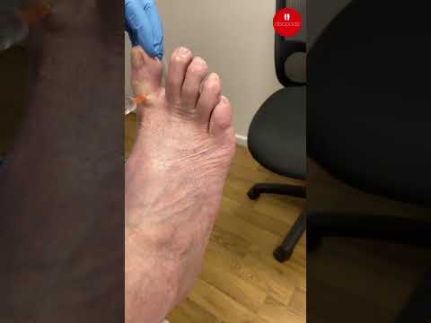 Understanding Local Anaesthetic Toe Injections