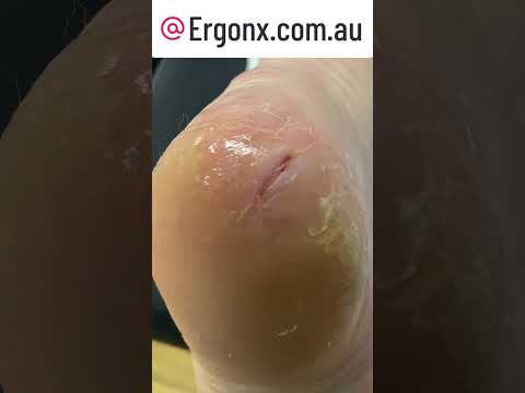 Transform Your Heels: Podiatrist's Cracked Callus Removal Treatment #S ...