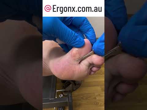Satisfying Big Toe Callus Removal by Expert Podiatrist #Podiatry #FootCare