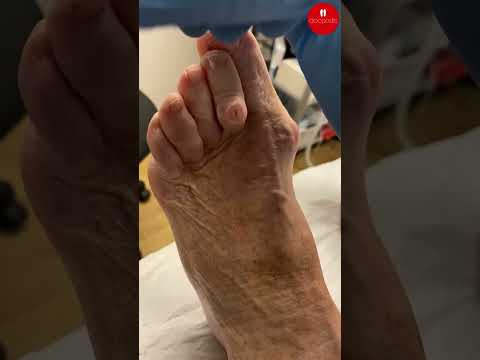 How Podiatrists Treat a Second Toe Corn Ulcer