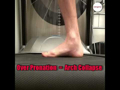 Overpronation: Why the Arch Drops and the Foot Lengthens
